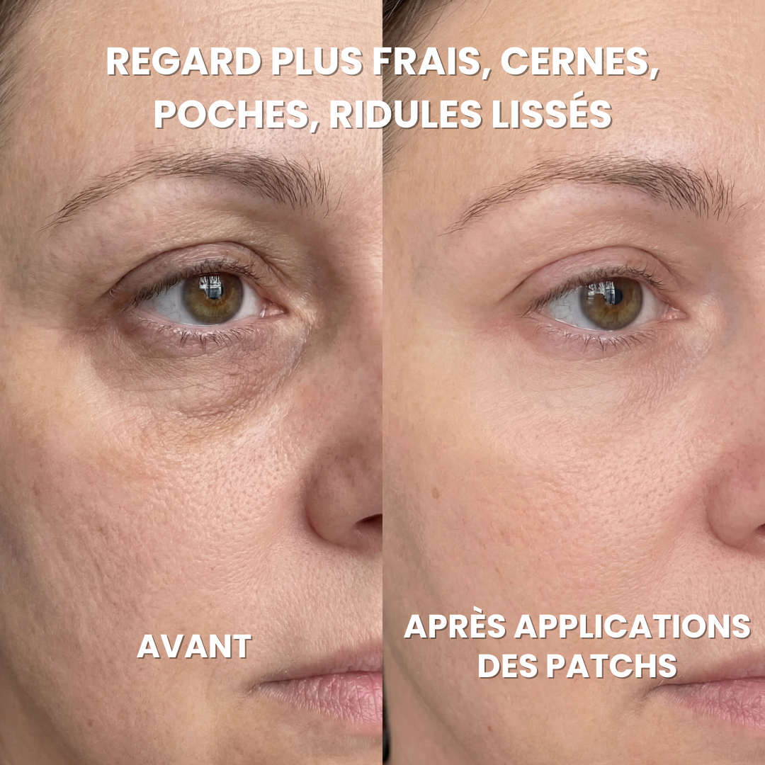Patchs Anti-Cernes à Micro-Infusion + Crème anti-âge offerte