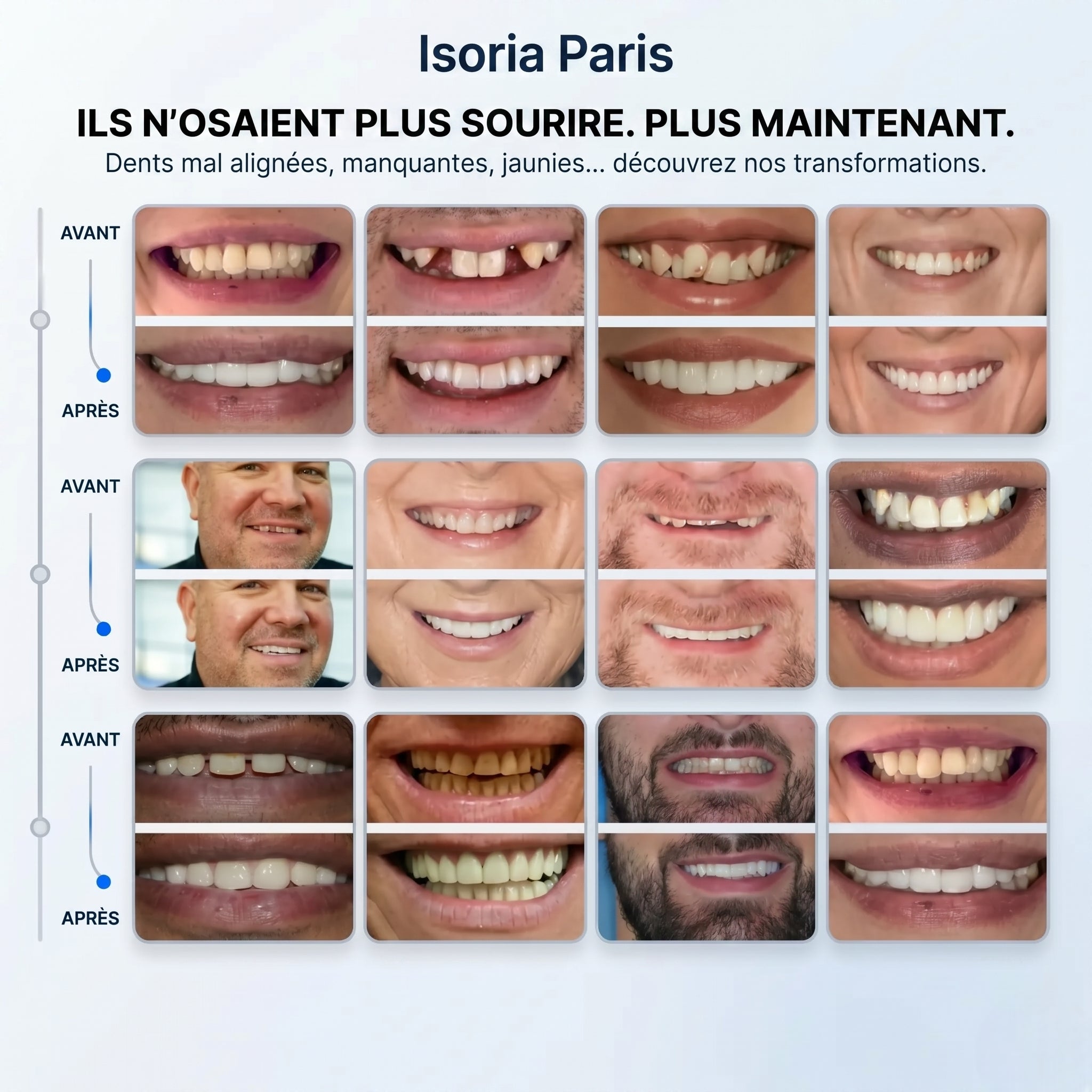 Kit complet de facettes clipsables (haut et bas) Isoria™